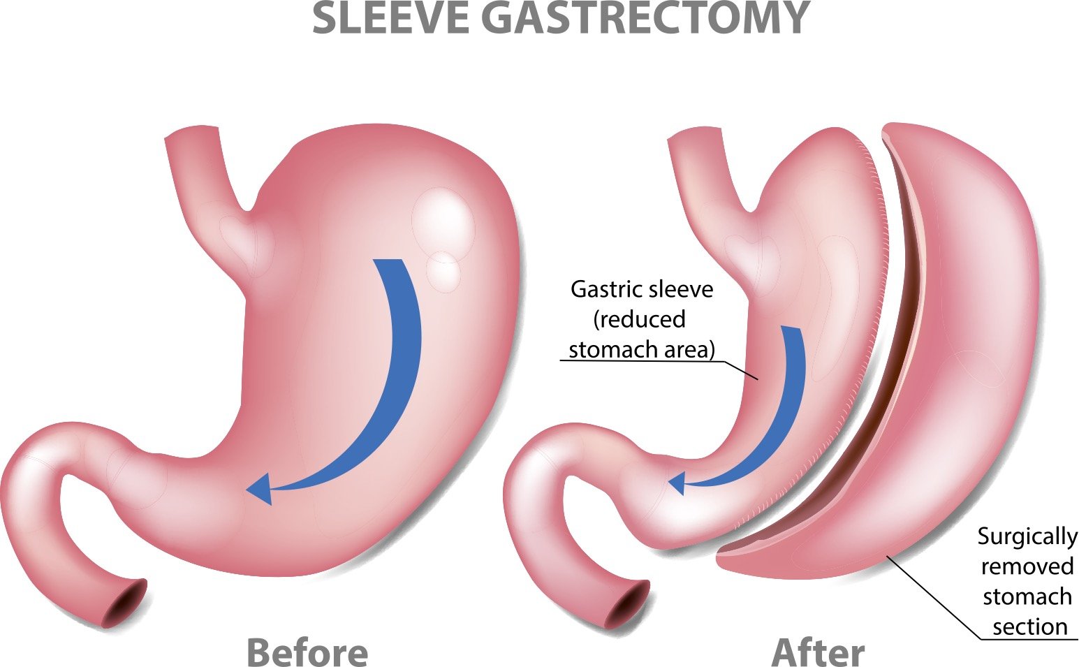 Gastric Sleeve