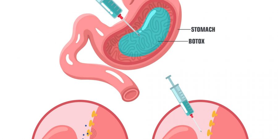Gastric Botox