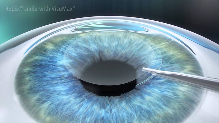 Relax Smile Laser Treatment