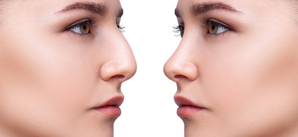 Rhinoplasty
