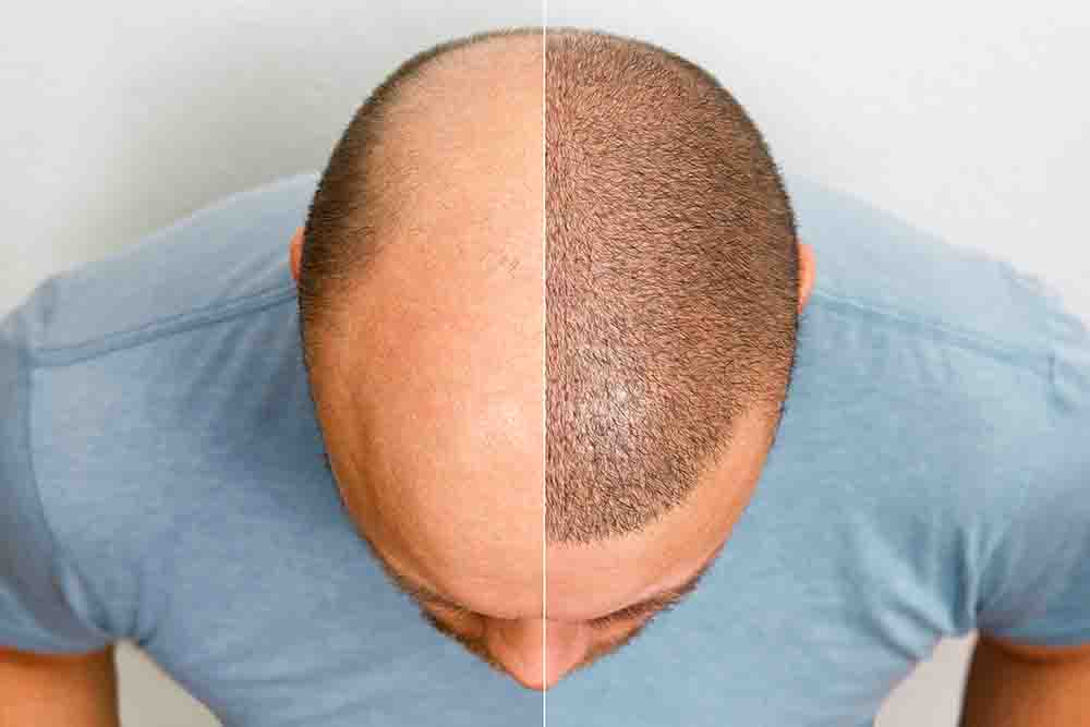 FUE Hair Transplantation